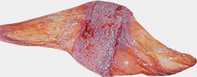 Placenta du foetus
