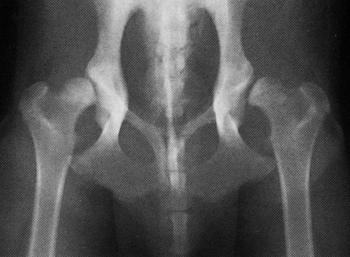 Dysplasie de la hanche