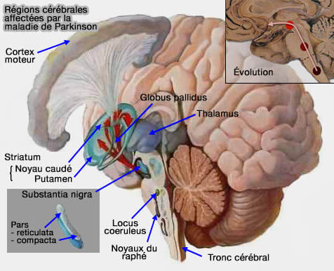 Régions cérébrales affectées par la maladie de Parkinson