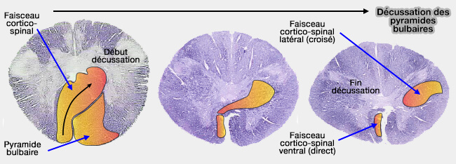 Décussation de la voie pyramidale bulbaire