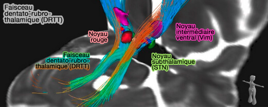 Faisceau dentato-rubro-thalamique (DRTT)