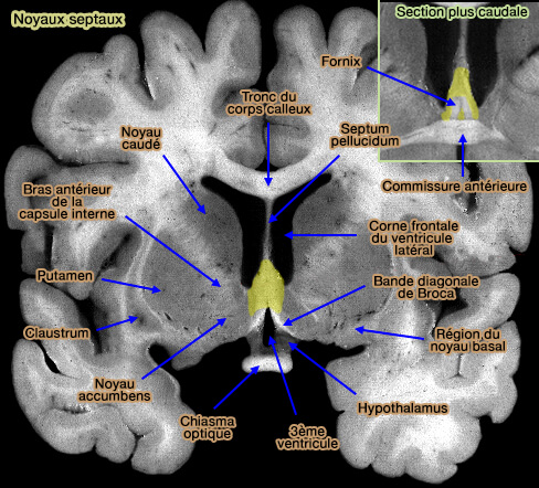Localisation des noyaux septaux