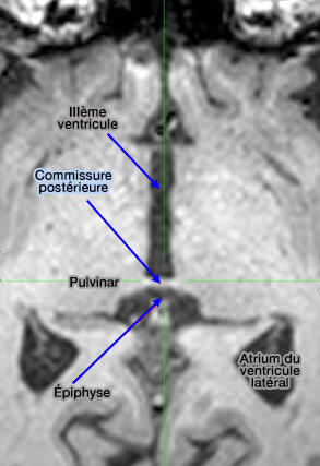 Voies olfactives de l'homme