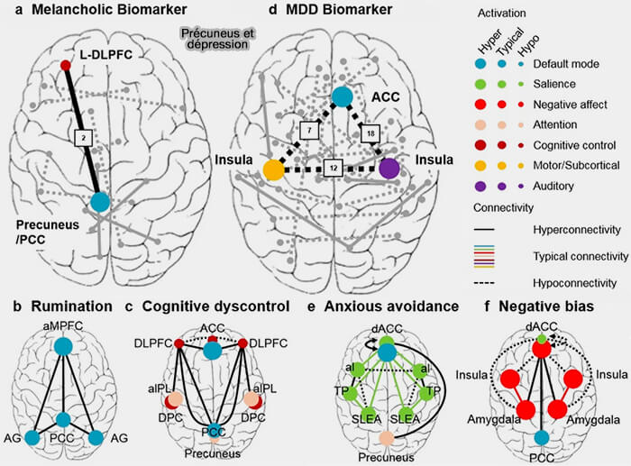 Précuneus et dépression