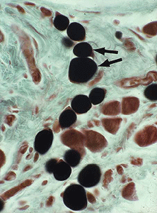 Adipocytes du tissu adipeux secondaire