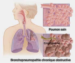 Bronchopneumopathie chronique obstructive