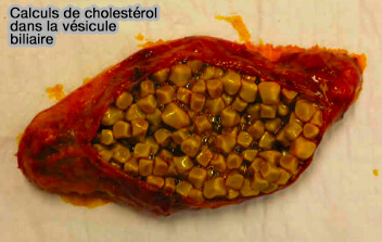 Calculs de cholestérol