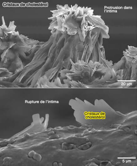 Cristaux de cholestérol