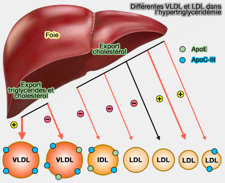 Différentes VLDL et LDL dans l'hypertriglycéridémie
