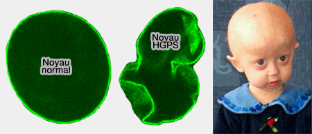 Structure aberrante du noyau dans l'HGPS