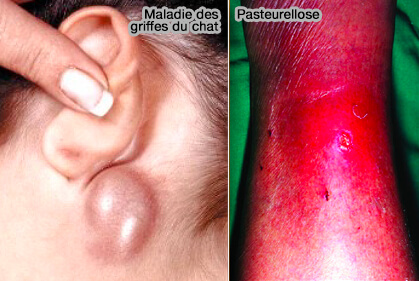 Maladie des griffes du chat et pasteurellose
