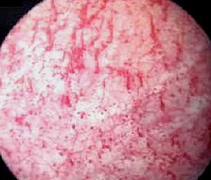 Cystite interstitielle (cystoscopie)