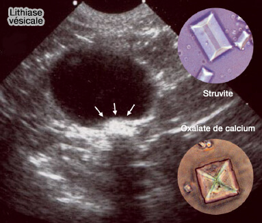 Lithiase vésicale