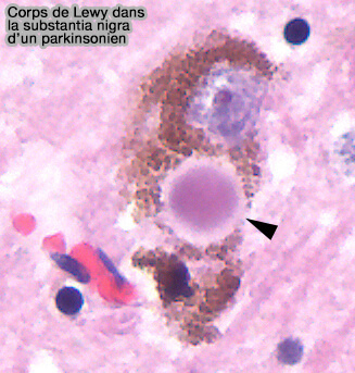 Corps de Lewy