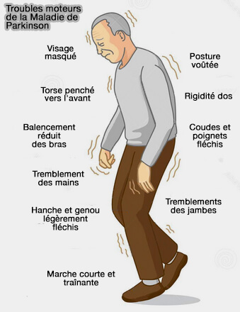 Régions cérébrales affectées par la maladie de Parkinson